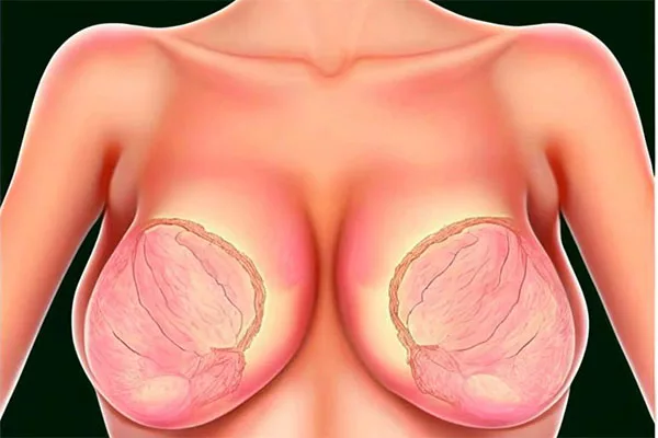 Tuberous breast cost